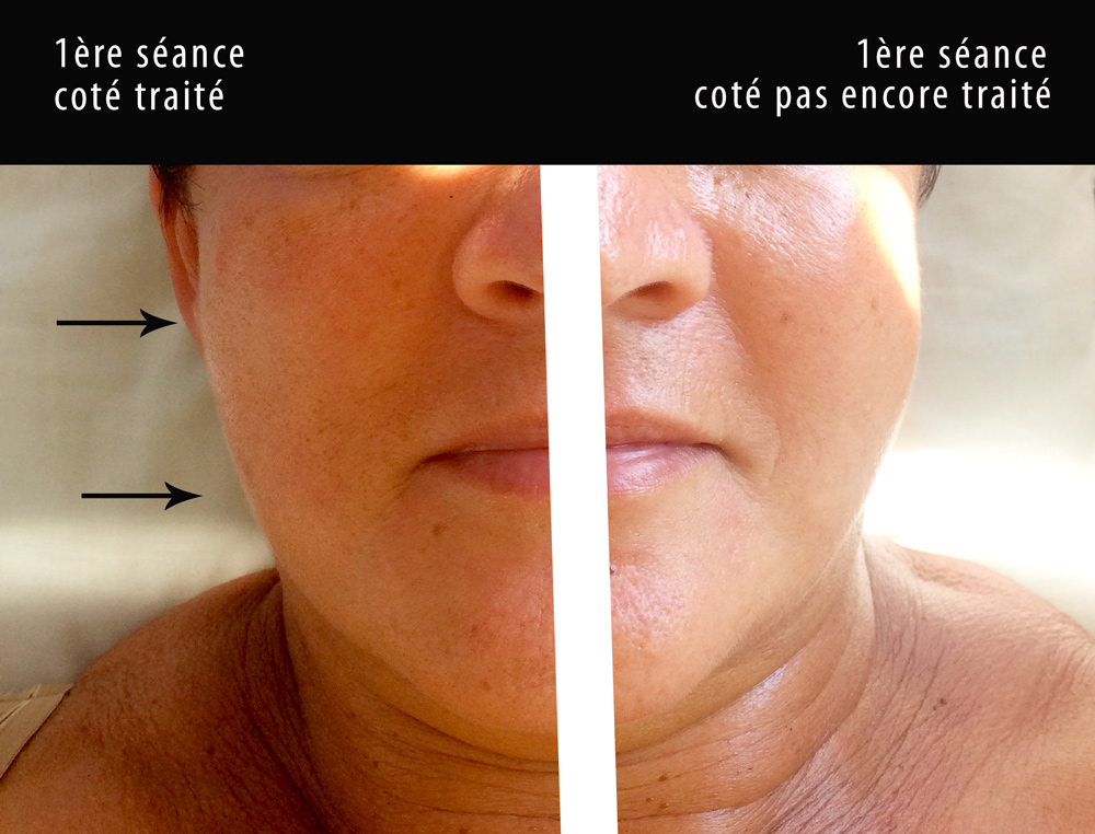 Résultat après la séance — tonicité et éclat retrouvés