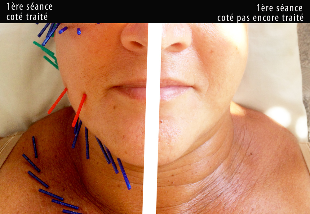 Pendant la séance — aiguilles faciales côté traité vs non traité