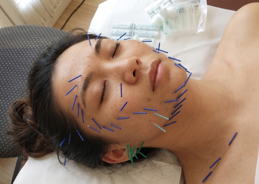 Aculifting — séance d'acupuncture esthétique du visage à Marseille
