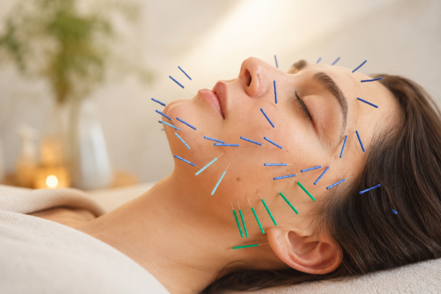 Résultats aculifting acupuncture esthétique Marseille